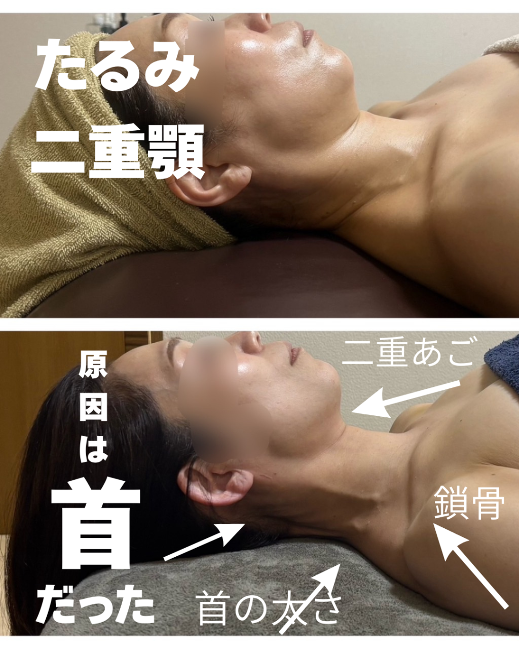 【たるみ、二十顎の原因は首だった！】